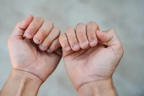 What are the 10 Health Warnings From Your Fingernails?